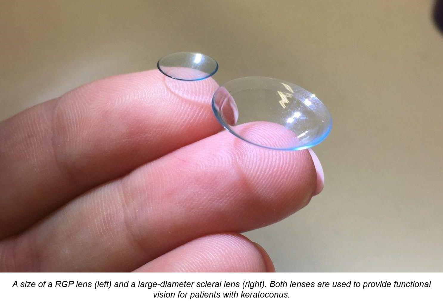 photo - rgp and scleral lens